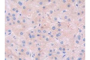 Detection of JAK2 in Human Liver cancer Tissue using Polyclonal Antibody to Janus Kinase 2 (JAK2) (JAK2 antibody  (AA 508-800))