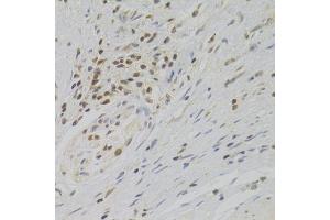 Immunohistochemistry of paraffin-embedded human gastric cancer using TAF1C Antibody.