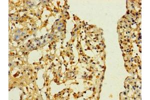 Immunohistochemistry of paraffin-embedded human bladder cancer using ABIN7170195 at dilution of 1:100 (SLC25A4 antibody  (AA 40-102))