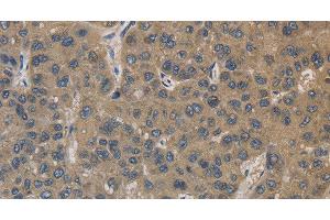 Immunohistochemistry of paraffin-embedded Human liver cancer using EMC8 Polyclonal Antibody at dilution of 1:30 (COX4NB antibody)