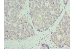 Immunohistochemistry of paraffin-embedded human gastric cancer using ABIN7142845 at dilution of 1:100 (RPL9 antibody  (AA 1-192))
