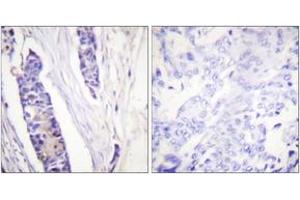 Immunohistochemistry analysis of paraffin-embedded human breast carcinoma tissue, using Tubulin beta Antibody. (TUBB antibody  (AA 401-450))