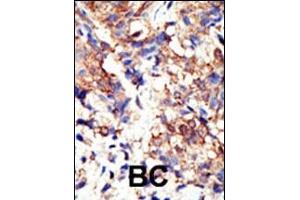 Formalin-fixed and paraffin-embedded human cancer tissue reacted with the primary antibody, which was peroxidase-conjugated to the secondary antibody, followed by DAB staining. (Ubiquilin 1 antibody  (N-Term))
