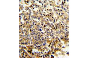 Formalin-fixed and paraffin-embedded human lymphoma reacted with NCF4 Antibody , which was peroxidase-conjugated to the secondary antibody, followed by DAB staining. (NCF4 antibody  (C-Term))