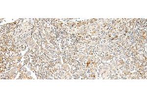 Immunohistochemistry of paraffin-embedded Human cervical cancer tissue using TAAR2 Polyclonal Antibody at dilution of 1:40(x200) (GPR58 antibody)