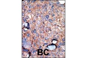 Formalin-fixed and paraffin-embedded human cancer tissue reacted with the primary antibody, which was peroxidase-conjugated to the secondary antibody, followed by AEC staining. (IKKi/IKKe antibody  (C-Term))