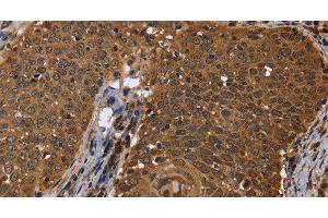 Immunohistochemistry of paraffin-embedded Human cervical cancer using DCP1A Polyclonal Antibody at dilution of 1:50 (DCP1A antibody)