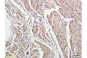 Formalin-fixed and paraffin embedded human lung carcinoma labeled with Anti-phospho-ROCK1(Thr455/Ser456) Polyclonal Antibody, Unconjugated (ABIN707771) at 1:200 followed by conjugation to the secondary antibody and DAB staining. (ROCK1 antibody  (pSer456, pThr455))