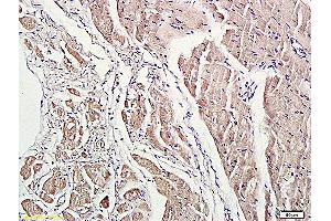 Formalin-fixed and paraffin embedded human lung carcinoma labeled with Anti-phospho-ROCK1(Thr455/Ser456) Polyclonal Antibody, Unconjugated (ABIN707771) at 1:200 followed by conjugation to the secondary antibody and DAB staining.