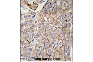 Formalin-fixed and paraffin-embedded human lung carcinoma tissue reacted with CLIC1 antibody, which was peroxidase-conjugated to the secondary antibody, followed by DAB staining. (CLIC1 antibody)
