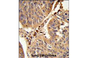 Formalin-fixed and paraffin-embedded human lung carcinoma reacted with PEX16 Antibody , which was peroxidase-conjugated to the secondary antibody, followed by DAB staining.