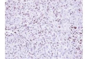 IHC-P Image Immunohistochemical analysis of paraffin-embedded H3347 xenograft , using ZNF707, antibody at 1:500 dilution. (ZNF707 antibody)