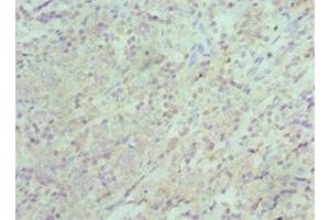 Immunohistochemistry of paraffin-embedded human colon cancer using ABIN7151313 at dilution of 1:100 (XIAP antibody  (AA 1-200))