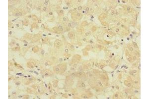 Immunohistochemistry of paraffin-embedded human gastric cancer using ABIN7151805 at dilution of 1:100 (TMPRSS15 antibody  (AA 40-300))