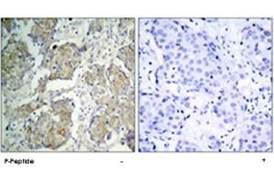 Immunohistochemical analysis of paraffin-embedded human breast carcinoma tissue using KDR (phospho Y1214) polyclonal antibody . (VEGFR2/CD309 antibody  (pTyr1214))