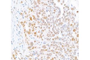 Immunohistochemistry (IHC) image for anti-MutL Homolog 1 (MLH1) (AA 450-500) antibody (ABIN7455102) (Recombinant MLH1 antibody  (AA 450-500))