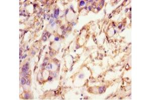 Immunohistochemistry of paraffin-embedded human pancreatic cancer using ABIN7168723 at dilution of 1:100 (SCAMP2 antibody  (AA 1-153))