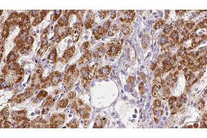 ABIN6278064 at 1/100 staining Human liver cancer tissue by IHC-P. (NMDAR2A antibody  (Internal Region))