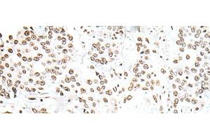 Immunohistochemistry of paraffin-embedded Human prost ate cancer tissue using SNRPA Polyclonal Antibody at dilution of 1:30(x200) (SNRPA1 antibody)