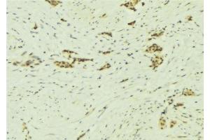ABIN6277335 at 1/100 staining Human breast cancer tissue by IHC-P. (NAP1L1 antibody  (C-Term))