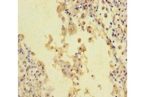 Immunohistochemistry of paraffin-embedded human lung cancer using ABIN7168626 at dilution of 1:100 (STIL antibody  (AA 388-637))
