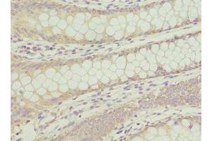 Immunohistochemistry of paraffin-embedded human colon cancer using ABIN7144072 at dilution of 1:100 (ANAPC2 antibody  (AA 1-230))