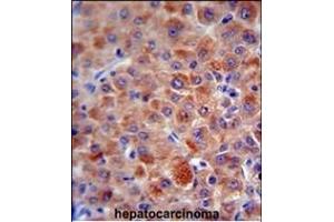 CFH antibody (Center) (ABIN654896 and ABIN2844545) immunohistochemistry analysis in formalin fixed and paraffin embedded human hepatocarcinoma followed by peroxidase conjugation of the secondary antibody and DAB staining. (Complement Factor H antibody  (AA 751-780))