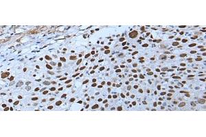 Immunohistochemistry of paraffin-embedded Human lung cancer tissue using ZNHIT3 Polyclonal Antibody at dilution of 1:80(x200) (ZNHIT3 antibody)