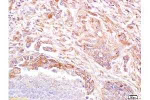 Formalin-fixed and paraffin embedded human lung carcinoma labeled with Anti PRSS8 Polyclonal Antibody (ABIN761891), Unconjugated at 1:200, followed by conjugation to the secondary antibody and DAB staining