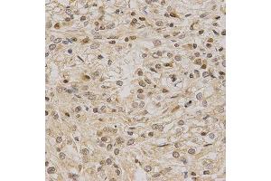 Immunohistochemistry of paraffin-embedded human kidney cancer using LETMD1 antibody at dilution of 1:200 (x400 lens) (LETMD1 antibody  (AA 161-360))