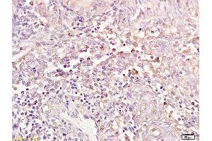 Formalin-fixed and paraffin embedded human endometrial carcinoma tissue labeled with Anti phospho-ER-beta(ser87) Polyclonal Antibody,Unconjugated (ABIN1387942) at 1:200 followed by conjugation to the secondary antibody and DAB staining. (ESR2 antibody  (pSer87))