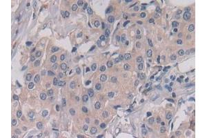 Detection of LGMN in Human Breast cancer Tissue using Polyclonal Antibody to Legumain (LGMN) (LGMN antibody  (AA 18-433))