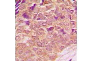 Immunohistochemical analysis of PI3K p85 alpha (pY607) staining in human breast cancer formalin fixed paraffin embedded tissue section. (PIK3R1 antibody  (C-Term, pTyr607))