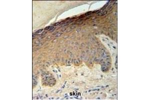 KRT35 Antibody (C-term) (ABIN651184 and ABIN2840116) IHC analysis in formalin fixed and paraffin embedded skin carcinoma followed by peroxidase conjugation of the secondary antibody and DAB staining. (Keratin 35 antibody  (C-Term))