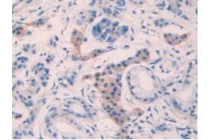 IHC-P analysis of Human Pancreas Cancer Tissue, with DAB staining. (IL10RB antibody  (AA 87-243))