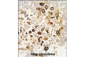 Formalin-fixed and paraffin-embedded human lung carcinoma tissue reacted with CYP4X1 antibody (N-term), which was peroxidase-conjugated to the secondary antibody, followed by DAB staining. (CYP4X1 antibody  (N-Term))