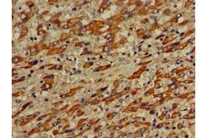 Immunohistochemistry of paraffin-embedded human liver cancer using ABIN7175308 at dilution of 1:100 (VPS33A antibody  (AA 1-300))