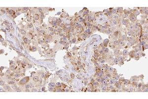ABIN6277922 at 1/100 staining Human Melanoma tissue by IHC-P. (Cathelicidin antibody  (Internal Region))