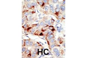 Formalin-fixed and paraffin-embedded human cancer tissue reacted with the primary antibody, which was peroxidase-conjugated to the secondary antibody, followed by DAB staining. (Dnmt2 antibody  (N-Term))