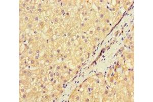 Immunohistochemistry of paraffin-embedded human liver cancer using ABIN7169570 at dilution of 1:100 (NEU1 antibody  (AA 201-415))
