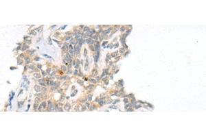 Immunohistochemistry of paraffin-embedded Human ovarian cancer tissue using CAMK2A Polyclonal Antibody at dilution of 1:55(x200) (CAMK2A antibody)