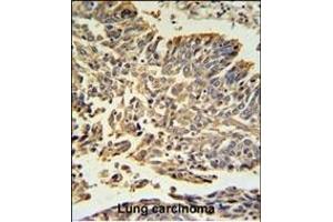 Hsp 27 Antibody (Center) (ABIN391300 and ABIN2841336) IHC analysis in formalin fixed and paraffin embedded human Lung carcinoma followed by peroxidase conjugation of the secondary antibody and DAB staining. (HSP27 antibody  (AA 108-136))