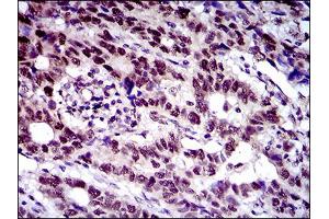 Immunohistochemical analysis of paraffin-embedded esophageal cancer tissues using CFLAR mouse mAb with DAB staining. (FLIP antibody  (AA 100-251))