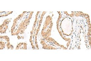 Immunohistochemistry of paraffin-embedded Human thyroid cancer tissue using RALGAPA1 Polyclonal Antibody at dilution of 1:55(x200) (GARNL1 antibody)