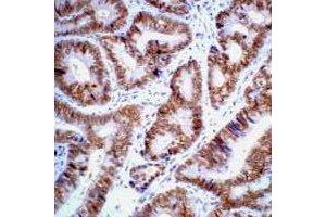 Immunohistochemistry (IHC) image for anti-Tumor Protein P53 (TP53) antibody (ABIN7305220)