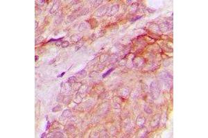 Immunohistochemical analysis of WASF1 (pY125) staining in human breast cancer formalin fixed paraffin embedded tissue section.