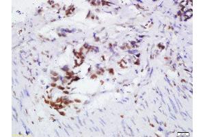Formalin-fixed and paraffin embedded human colon cancer labeled with Rabbit Anti-OGG1 Polyclonal Antibody, Unconjugated 1:200 followed by conjugation to the secondary antibody and DAB staining (OGG1 antibody  (AA 151-250))