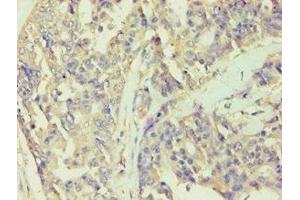 Immunohistochemistry of paraffin-embedded human endometrial cancer using ABIN7141988 at dilution of 1:100 (BCKDK antibody  (AA 153-412))
