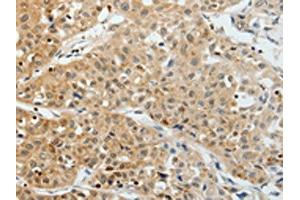 The image on the left is immunohistochemistry of paraffin-embedded Human lung cancer tissue using ABIN7193012(VEGFA Antibody) at dilution 1/25, on the right is treated with synthetic peptide. (VEGFA antibody)