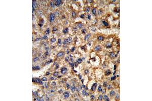 Formalin-fixed and paraffin-embedded human hepatocarcinoma reacted with HSD17B12 Antibody (Center), which was peroxidase-conjugated to the secondary antibody, followed by DAB staining. (HSD17B12 antibody  (AA 126-155))